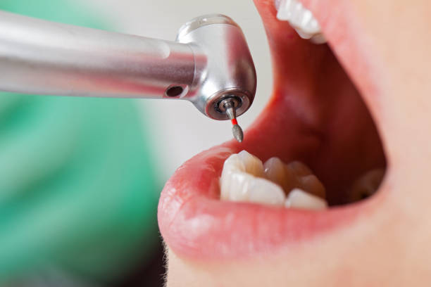 Best Emergency Wisdom Teeth Removal in Whitewater, WI